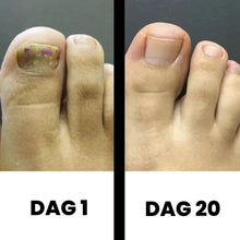 Afbeelding in Gallery-weergave laden, DermaNail - Gepatenteerde nagelschimmeltherapie – voor gezonde nagels binnen 4 weken